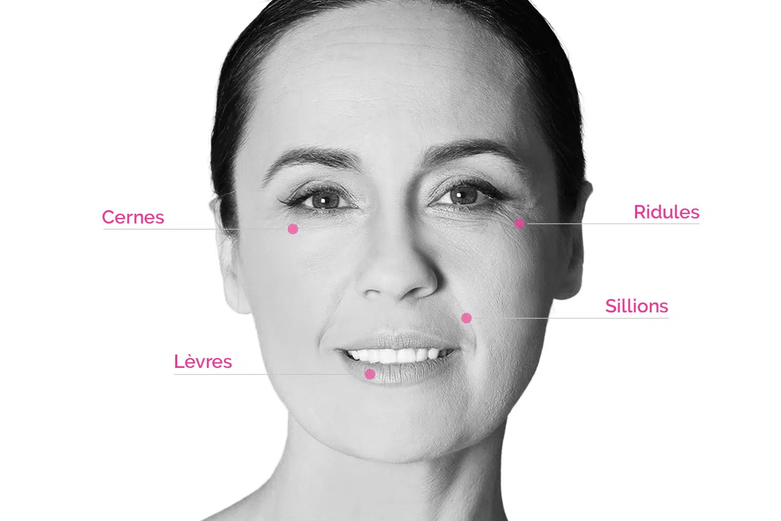 Retrouvez une belle peau grâce aux injections d'acide hyaluronique à Antibes, proche de Cannes